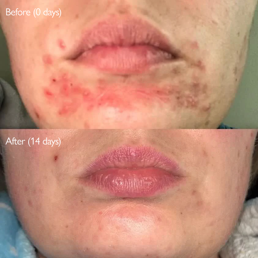 customers photos before and after using hemp seed oil from wild rising skincare